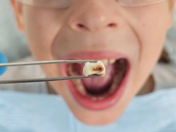 Best Emergency Broken Tooth Repair in Salem, IL